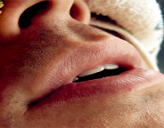 sleep-apnea